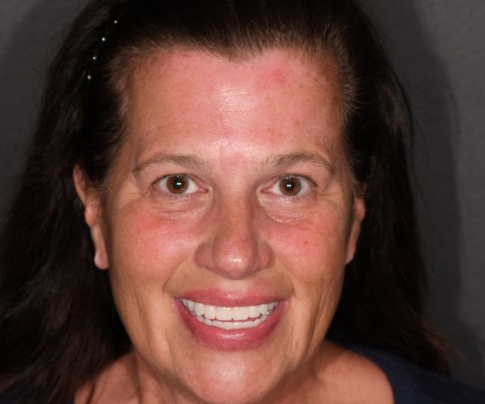 Woman smiling after cosmetic dentistry treatment