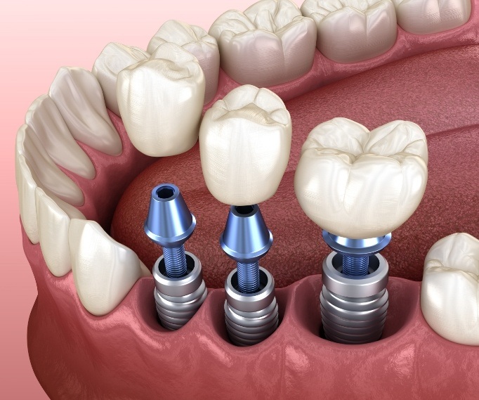 Three illustrated dental crowns being placed onto three dental implants