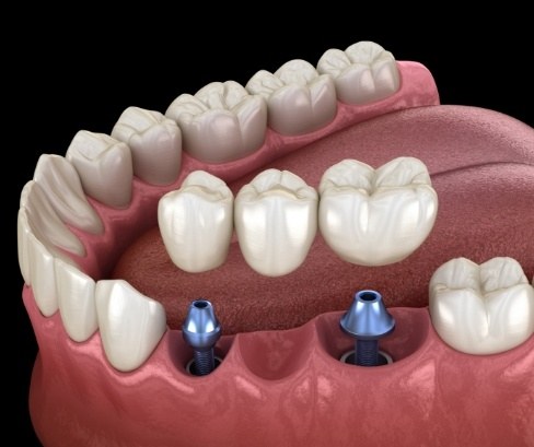 Illustrated dental bridge being fitted onto two dental implants