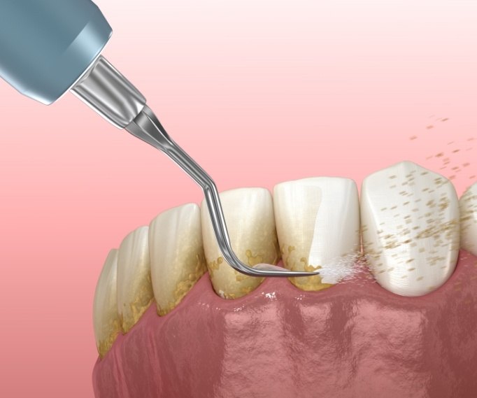 Illustrated dental scaler removing plaque buildup from teeth