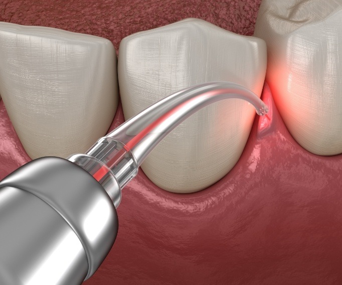 Illustrated laser treating gum disease