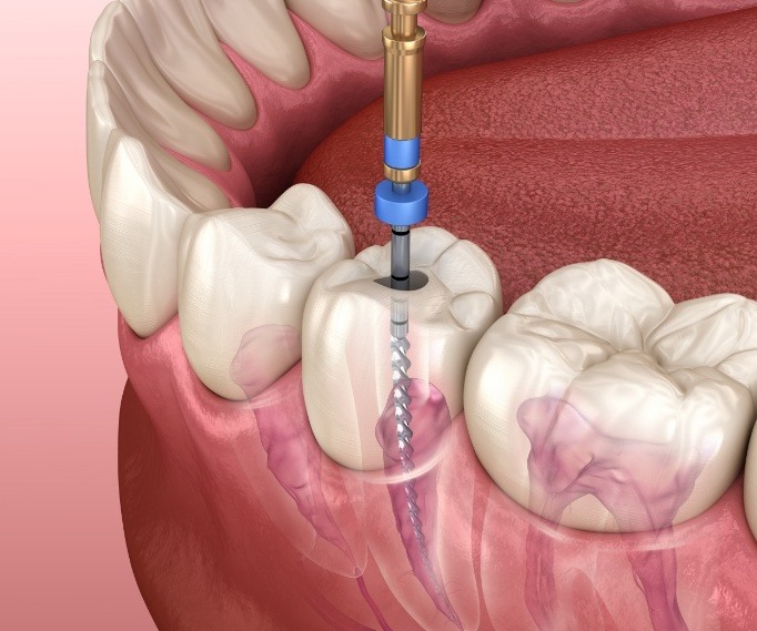 Illustrated dental instrument treating inside of tooth during root canal treatment